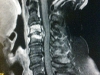 T1 showing Acute-on-top-of-chronic cervical spondylosis bout