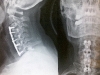4 discs surgery with 4 cages, screws and plate